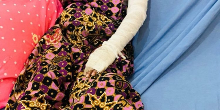 Kondisi Terkini Istri Siri di Indramayu usai Dibakar Suaminya 